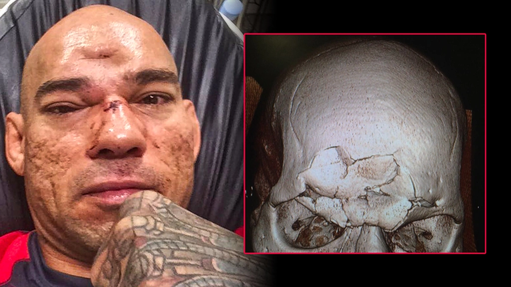 cyborg santos mvp knee ko , cyborg skull, cyborg santos skull x-ray