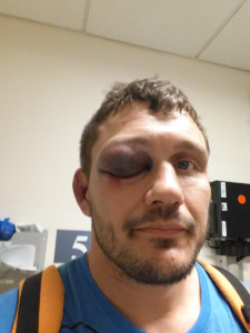 Mitriones eye, eye poke mma injury, worst mma injuries, mma injury