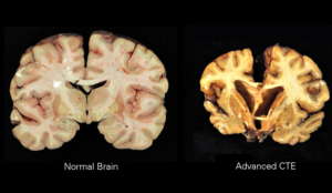 What is CTE? CTE, CTE brain